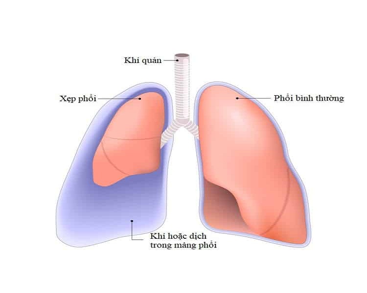 Xẹp phổi là một nguyên nhân dẫn đến tràn dịch màng phổi.
